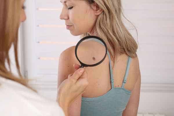What Are Traditional Skin Lesion Removal Methods Ilkeston?