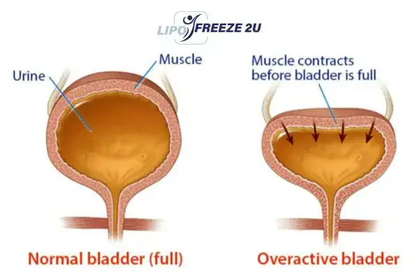 diagram of overactive bladder treatment Ilkeston