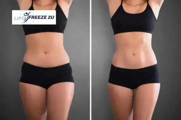 How Can LIPO FREEZE 2U Support Your Post-Pregnancy Body Recovery Ilkeston?