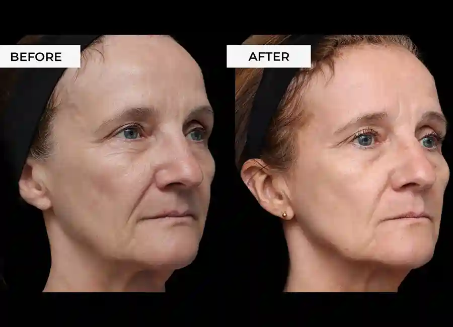 How Many RF Microneedling Sessions Will You Need to See a Difference Ilkeston?