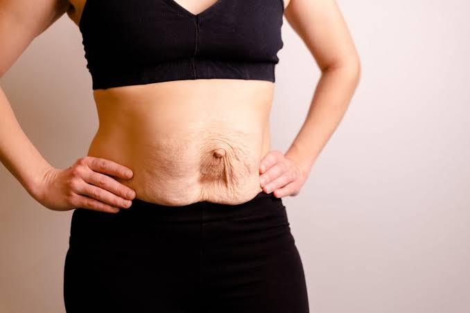 Is Surgery Really the Only Way to Repair Diastasis Recti Ilkeston?