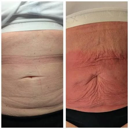 How Does RF Microneedling Improve Crepey, Thin and Uneven Skin Texture Ilkeston?
