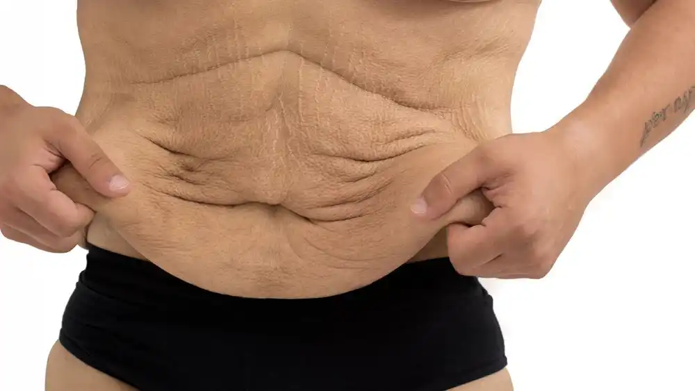 Why Does Weight Loss Medication Leave Some People With Loose or Sagging Skin Ilkeston?